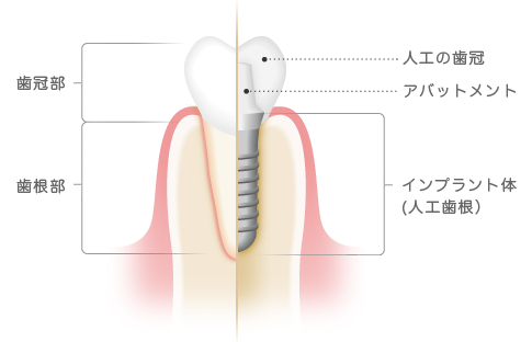 インプラント治療 インプラントの構造