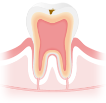 虫歯治療　C1