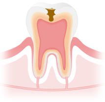虫歯治療　C2