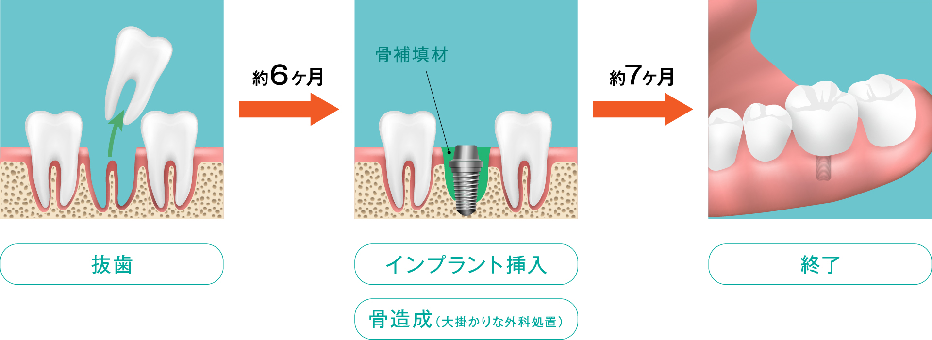 おだ歯科クリニックの通常の流れのインプラント挿入