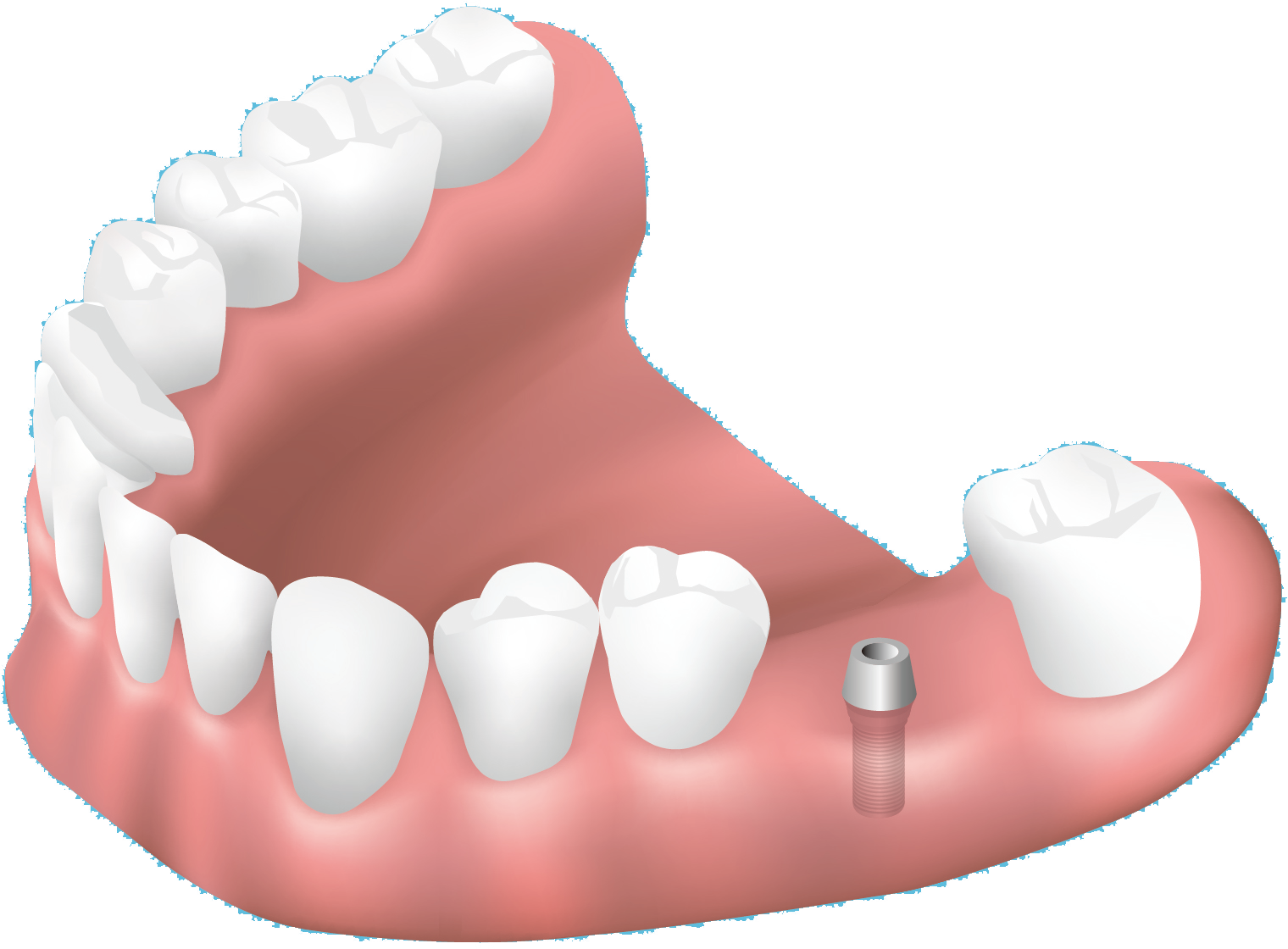 インプラントを埋め込む歯ぐきイメージ｜瑞枝の歯医者 おだ歯科クリニック