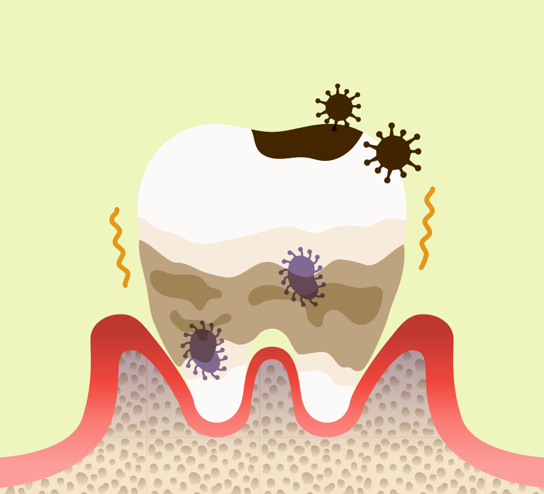 歯周病菌と虫歯菌の違い|おだ歯科クリニック