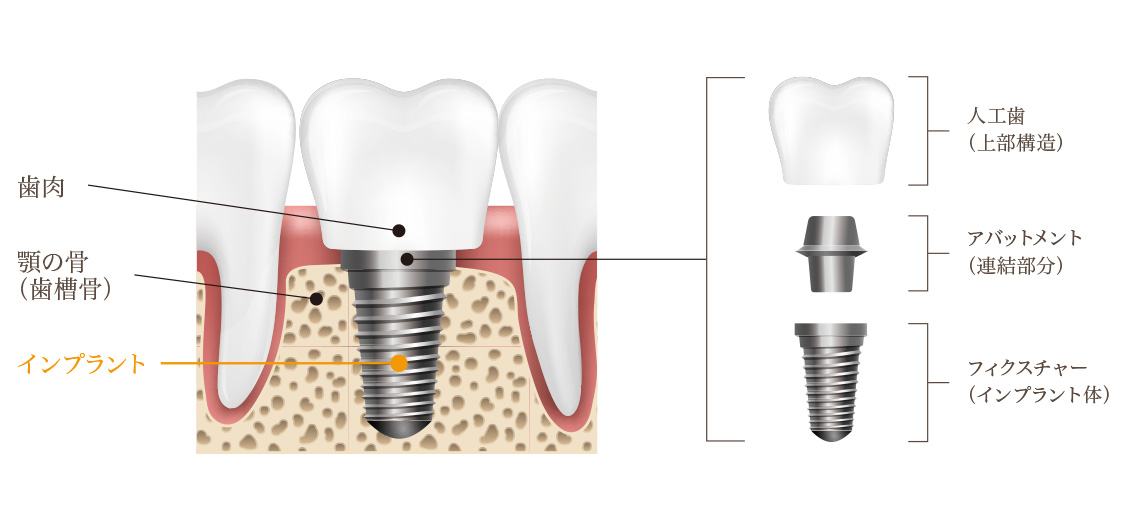 インプラント・おだ歯科クリニック・江戸川区瑞江