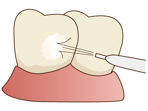 歯のクリーニング・メインテナンス