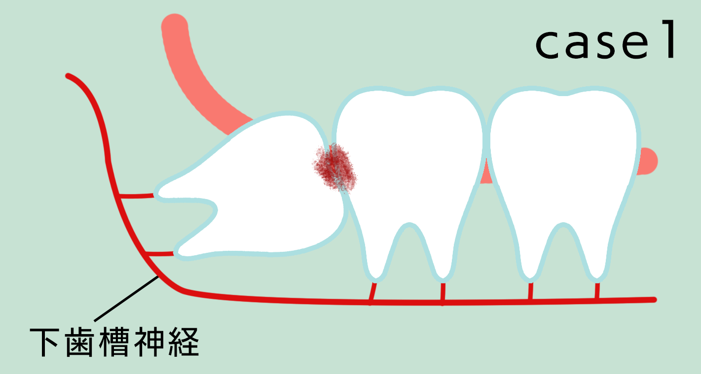 親知らずが虫歯・おだ歯科・江戸川区瑞江