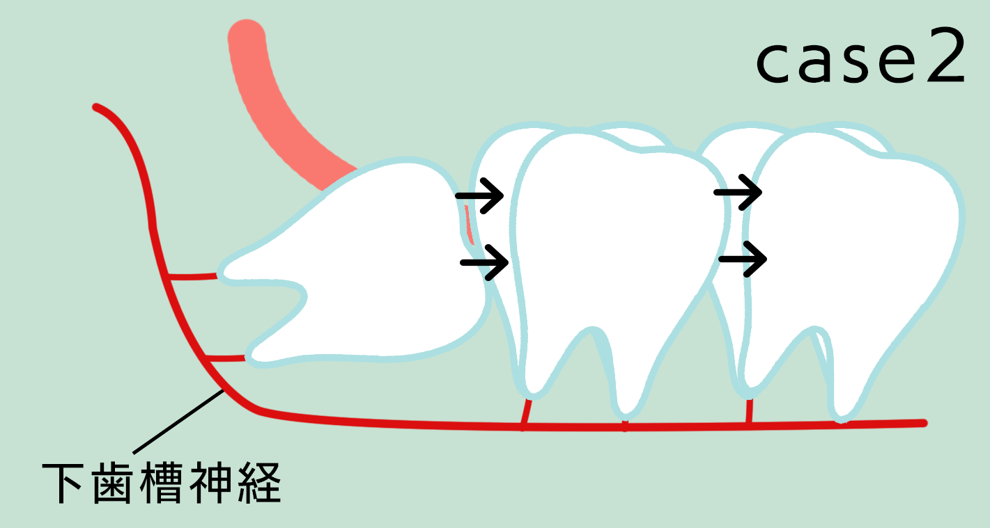 歯並びが悪くなる親知らず・おだ歯科・江戸川区瑞江