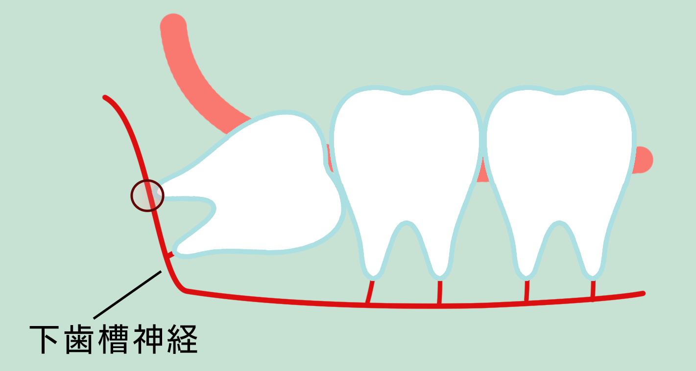 下歯槽神経に歯が密着している・おだ歯科・江戸川区瑞江