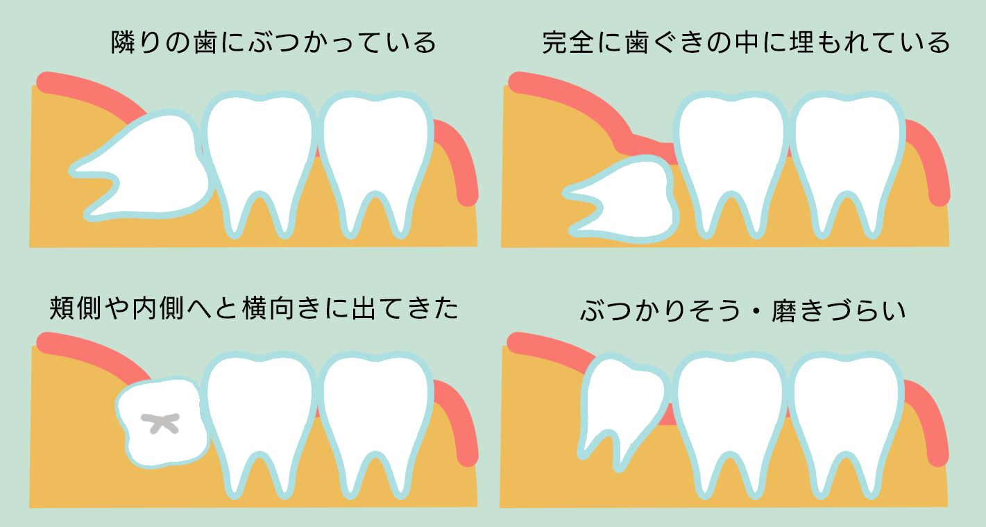 親知らずの生え方・おだ歯科・江戸川区瑞江