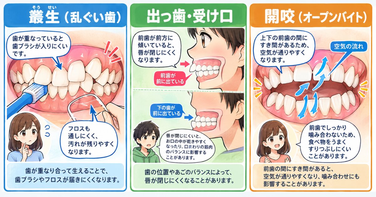 不正咬合の種類別に見る口臭のリスクと特徴